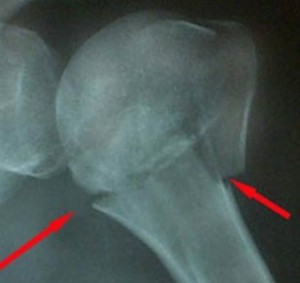 Рентген плеча Диагностика проводится с помощью рентгенографии плеча