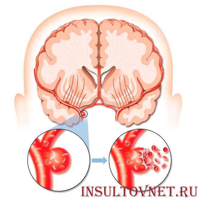 разрыв аневризмы