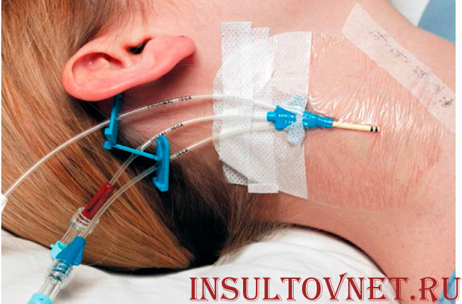 центральный венозный катетер