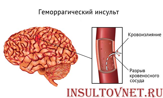 Геморрагический инсульт