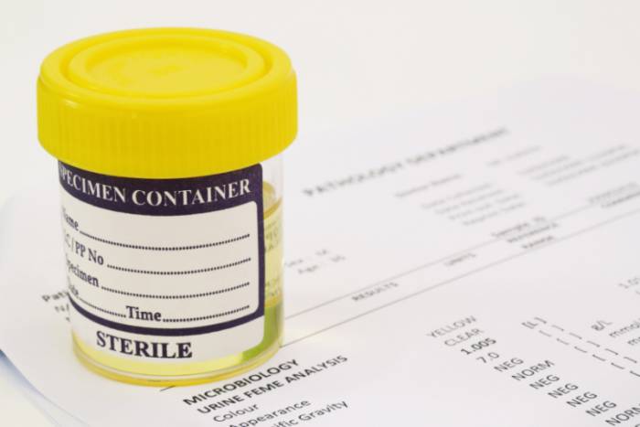 анализ мочи