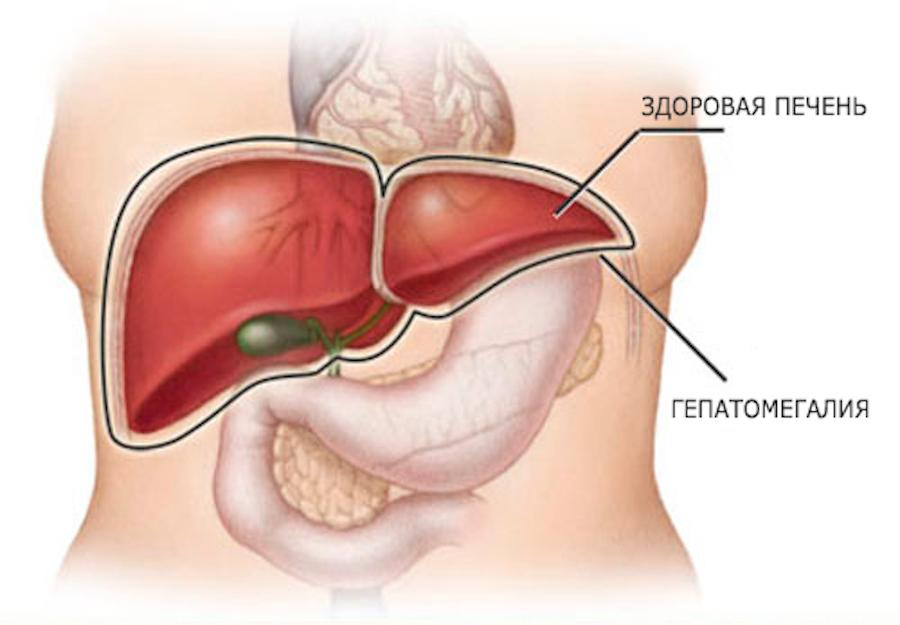 Симптомы и признаки увеличения печени (гепатомегалии)