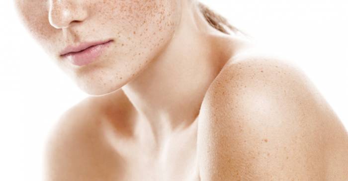 веснушки на кожи