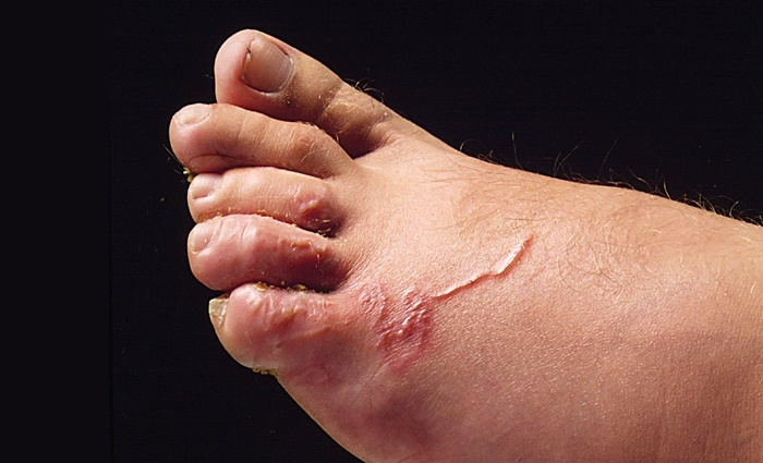 кожный токсокароз