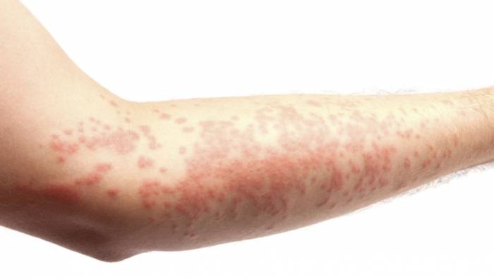 высыпания на коже