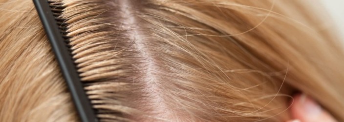 лечение вшей