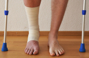 Нога в гипсе Перелом лодыжки