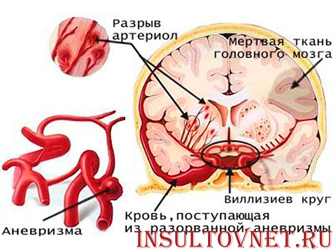 аневризма мозговых сосудов