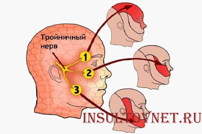 Воспаление тройничного нерва