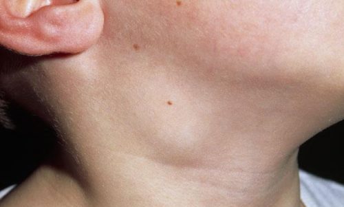 Симптомы лимфоузлы