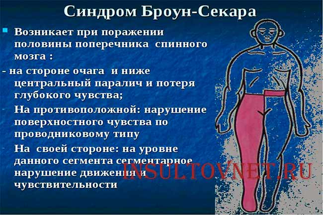 Синдром Броун-Секара