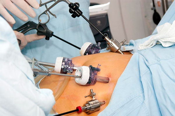 Грыжа живота у женщин - причины, симптомы, признаки, лечение хирургическим путем