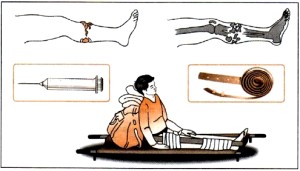 Перелом нижних конечностей Оказании первой медицинской при переломе ноги