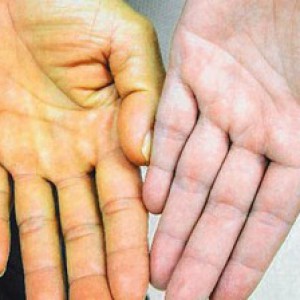 Осложнения и последствия синдрома Жильбера