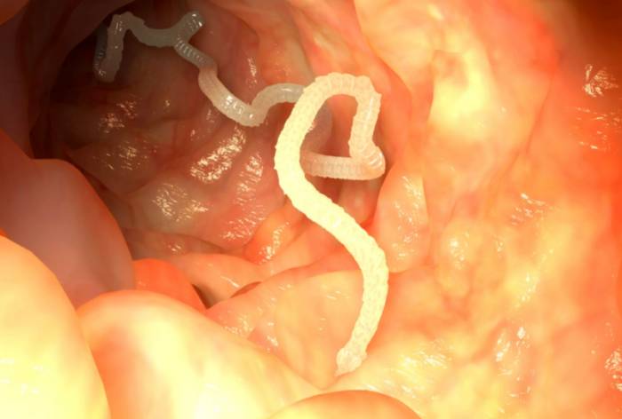 глисты в кишечнике