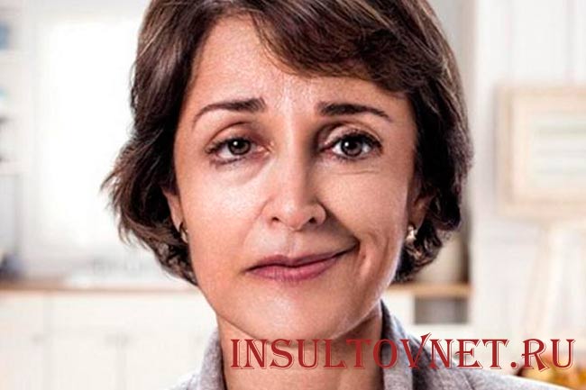 Инсульт и его последствия