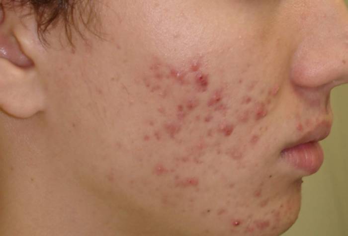 угри на лице