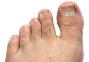 Болезнь ногтей на ногах и лечение