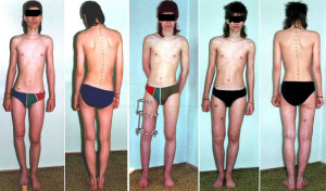 До и после удлинения ног Удлинение ног при помощи аппарата Илизарова