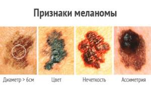 Признаки меланомы и ее симптомы