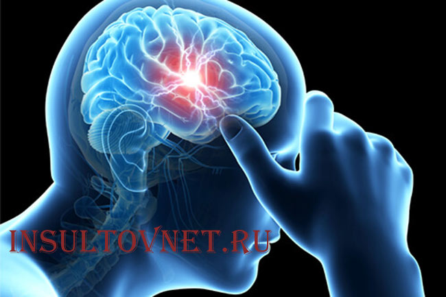 ТИА и риск инсульта