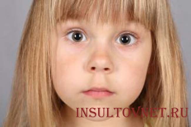 Абсанс у детей