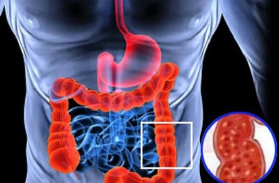 Амебиаз кишечный