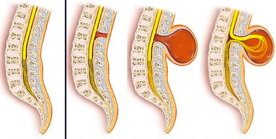Эффективные методы диагностики и лечения спинномозговой грыжи