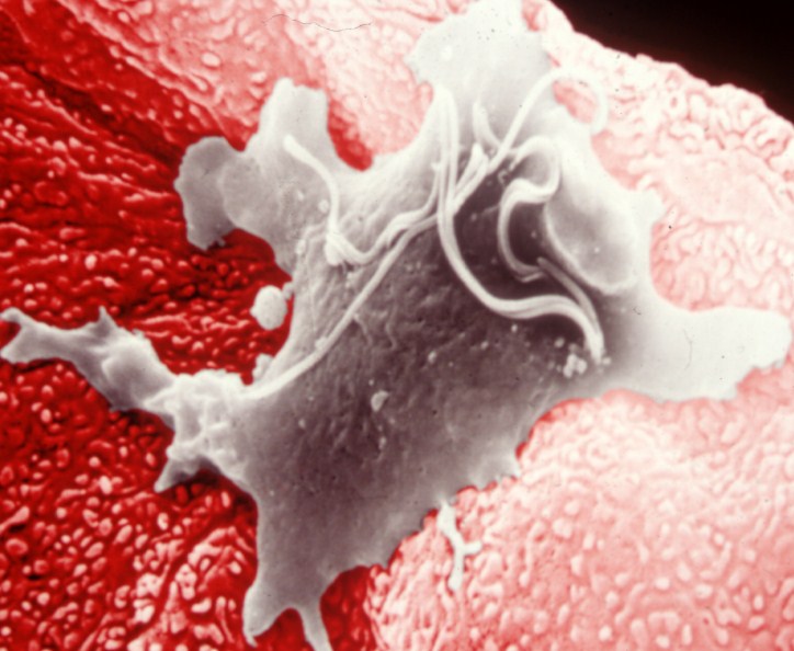 трихомониаз