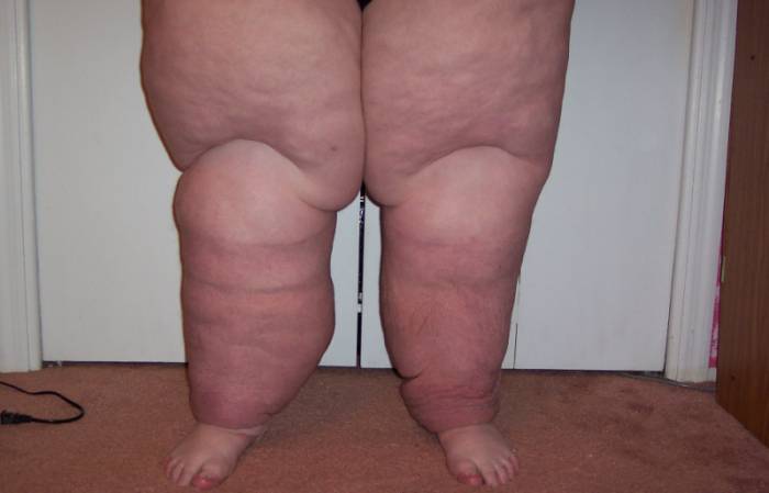 Слоновая болезнь