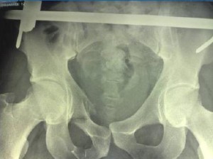 Снимок рентгена Рентген тазовых костей и крестца