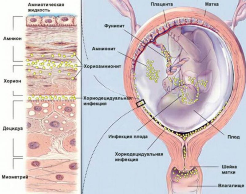 гонорея у беременной