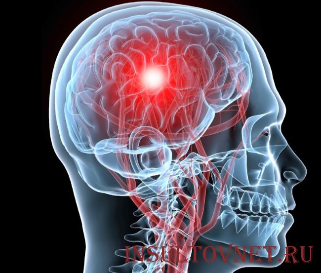 Геморрагический инсульт головного мозга