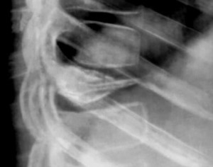 Рентген позвоночника Болезнь Кальве рентген