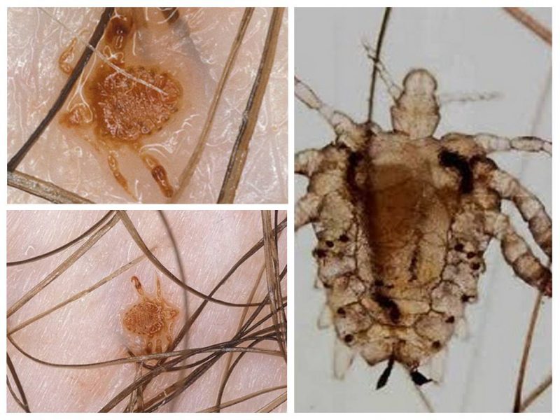 Педикулез у детей