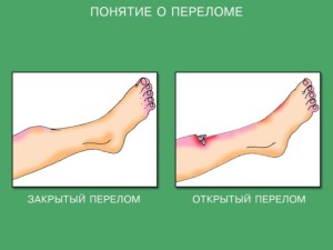 Виды переломов Закрытый и открытый перелом
