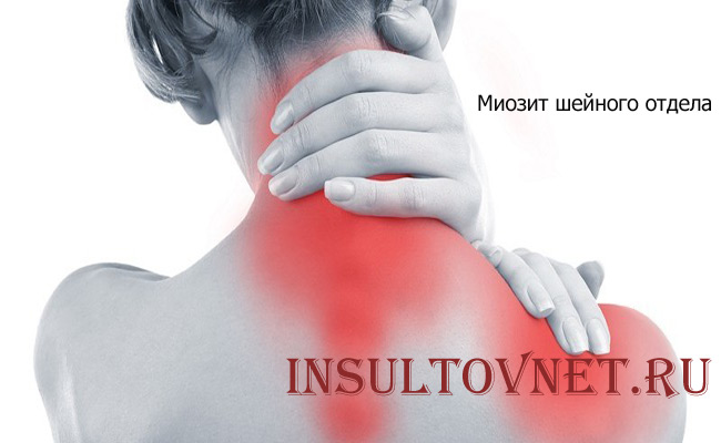Миозит шейного отдела