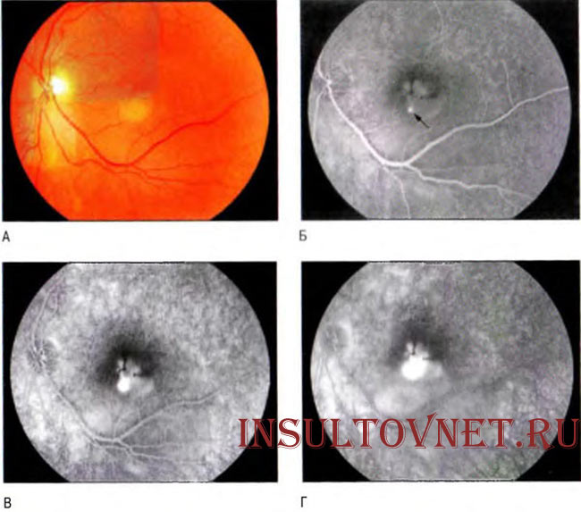 Исследование глазного дна