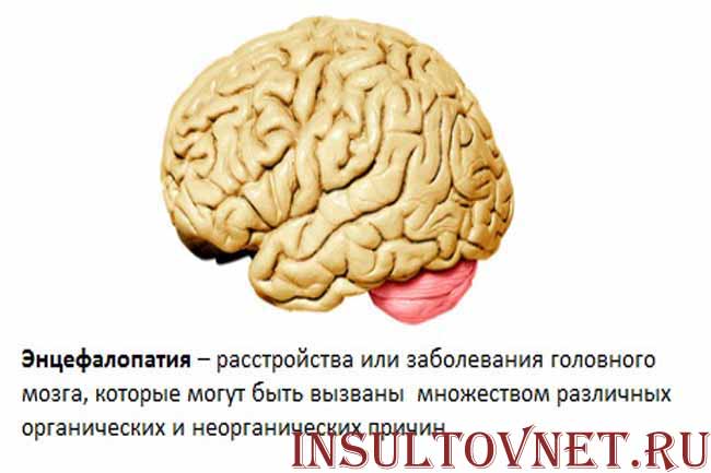 Что такое энцефалопатия
