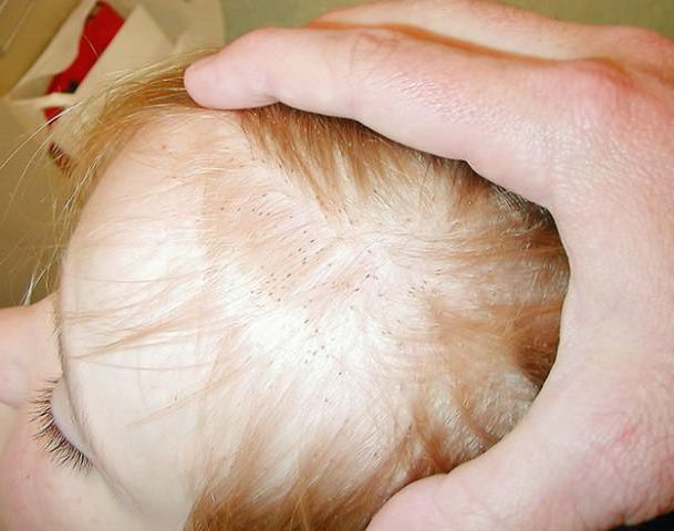 Признаки присутствия вшей на голове у человека