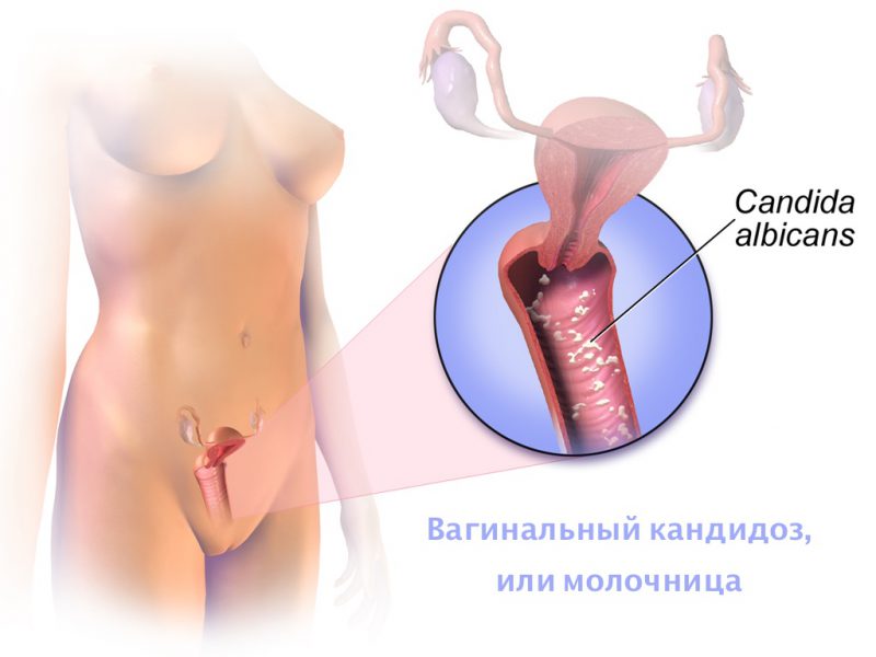 вагинальный кандидоз