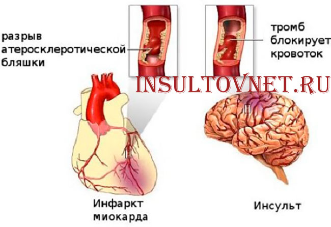 инфаркт и инсульт