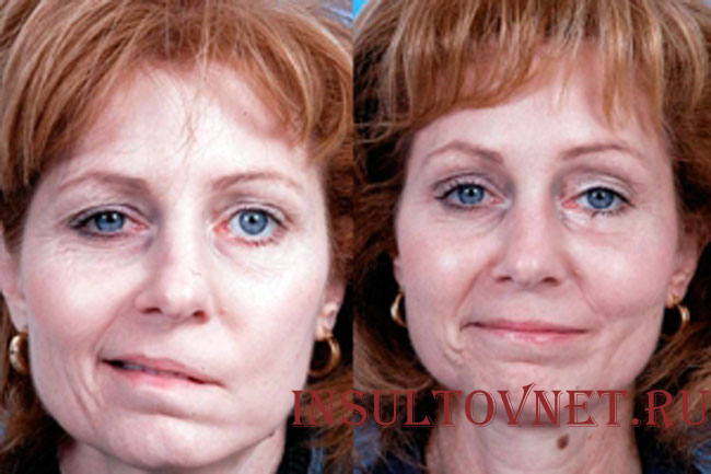 Особенности правостороннего поражения