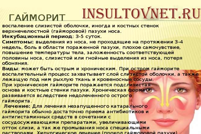 Симптомы гайморита