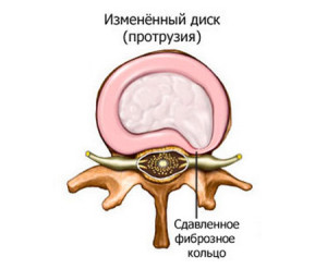 Измененный межпозвонковый диск Выпадение желеобразного ядра