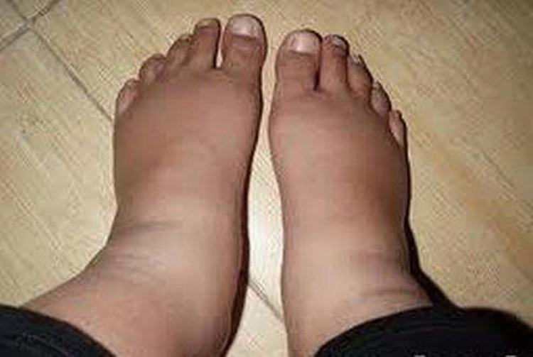 симптомы филяриоза