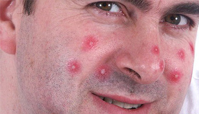 гнойные прыщи у мужчин