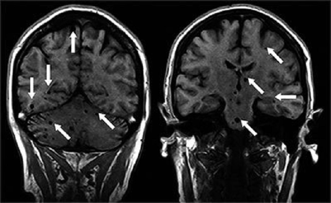 Эхинококкоз головного мозга