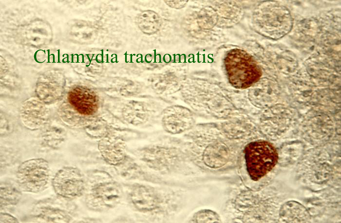 Chlamydia trachomatis