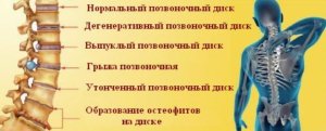 Симптомы боли в поясничной области